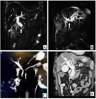 Comparison of MRCP and ERCP in the evaluation of common bile duct and pancreatic duct pathologies